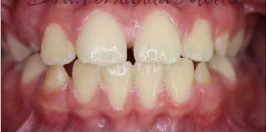 Sorriso antes do segundo tratamento com Invisalign na Mello & Rubio Odontologia