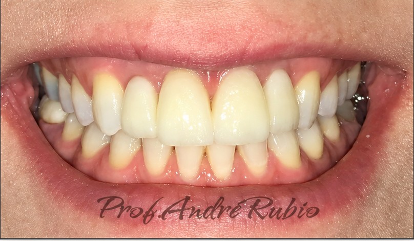 Sorriso reabilitado depois do primeiro tratamento com implantes na Mello & Rubio Odontologia