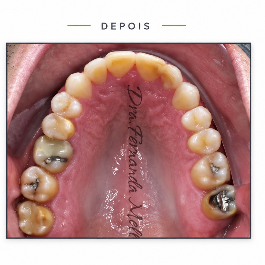 Arcada dentária depois do terceiro tratamento com Invisalign na Mello & Rubio Odontologia