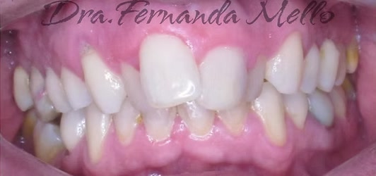 Sorriso antes do primeiro tratamento com Invisalign na Mello & Rubio Odontologia