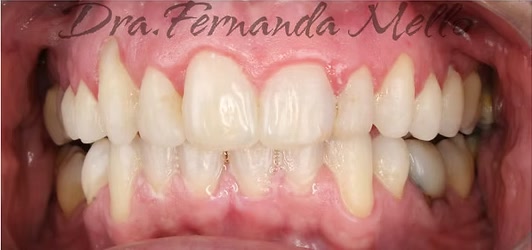 Sorriso depois do primeiro tratamento com Invisalign na Mello & Rubio Odontologia