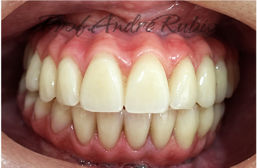 Sorriso reabilitado depois do segundo tratamento com implantes realizado pelo Prof. André Rubio