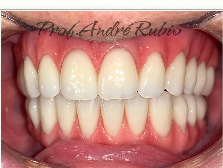 Sorriso reabilitado depois do terceiro tratamento com implantes realizado pelo Prof. André Rubio