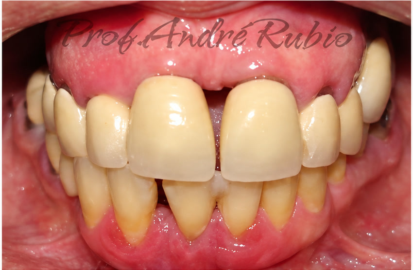 Sorriso antes do segundo tratamento com implantes realizado pelo Prof. André Rubio