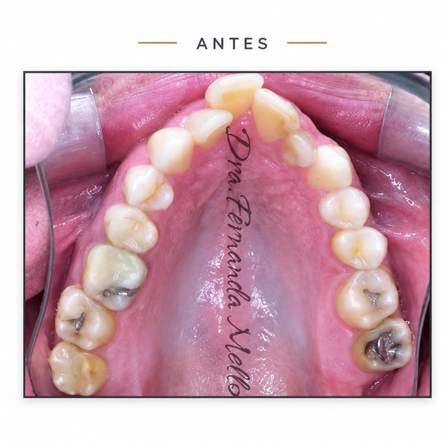 Arcada dentária antes do terceiro tratamento com Invisalign na Mello & Rubio Odontologia