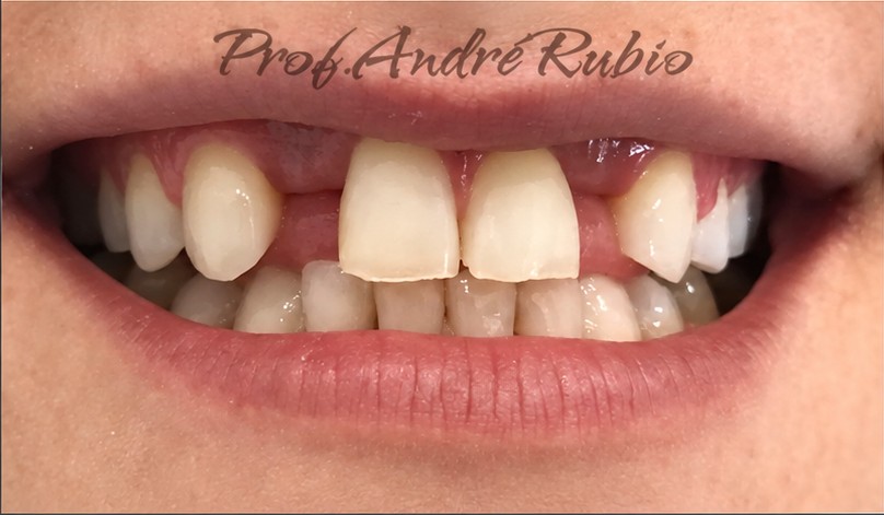 Sorriso antes do primeiro tratamento com implantes na Mello & Rubio Odontologia