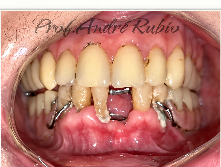 Sorriso antes do terceiro tratamento com implantes realizado pelo Prof. André Rubio