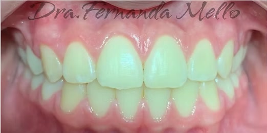 Sorriso depois do segundo tratamento com Invisalign na Mello & Rubio Odontologia